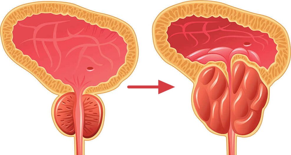 Próstata - normal e inflamada