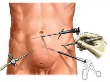 tratamento cirúrgico da prostatite crônica