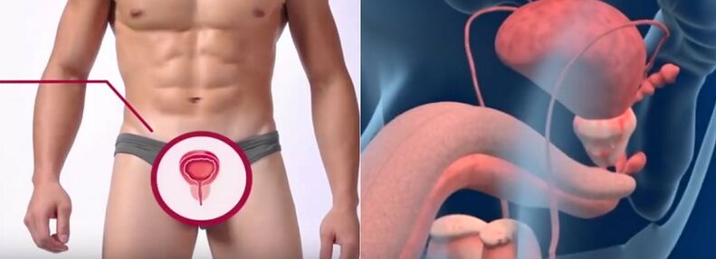 Prostatite em homens, reconhecível por certos sinais