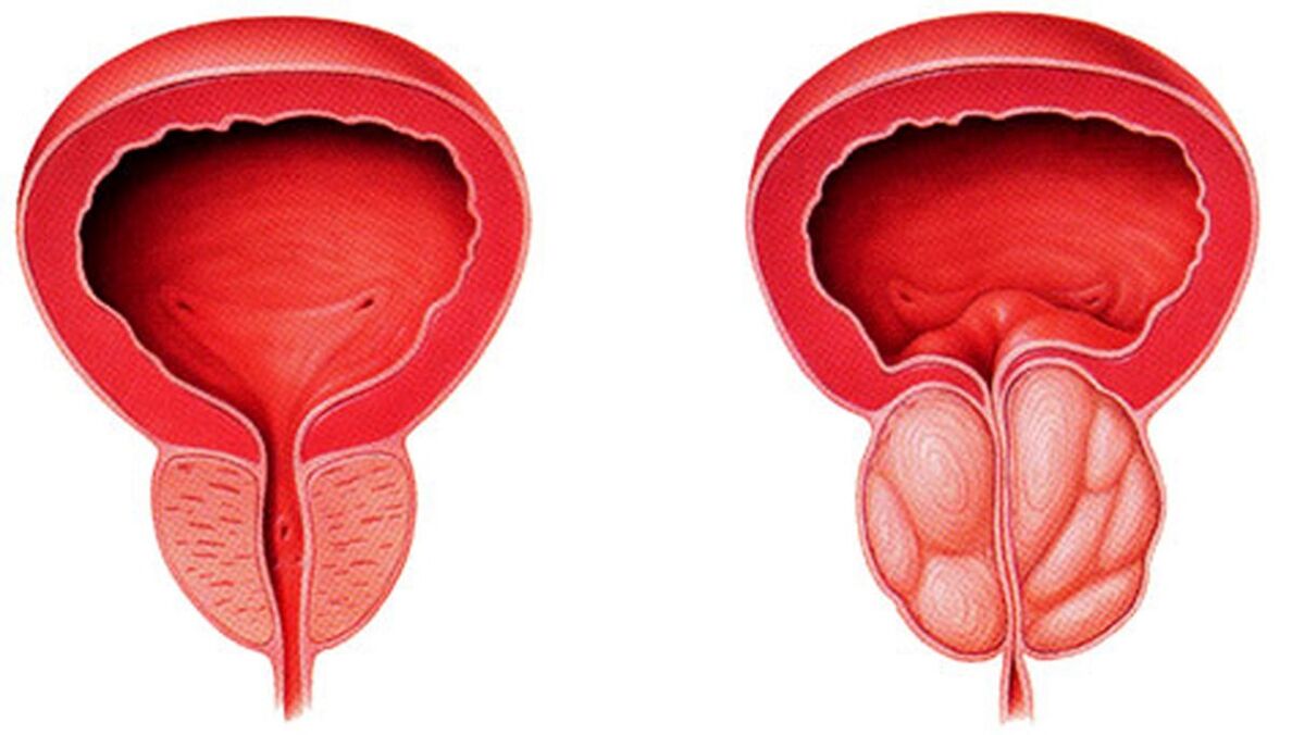 próstata saudável e inflamada com prostatite