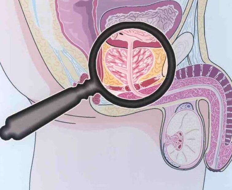 Derrota do tecido prostático em pacientes com prostatite crônica em homens